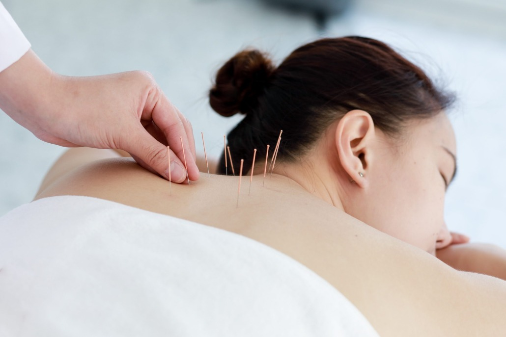 Dry Needling